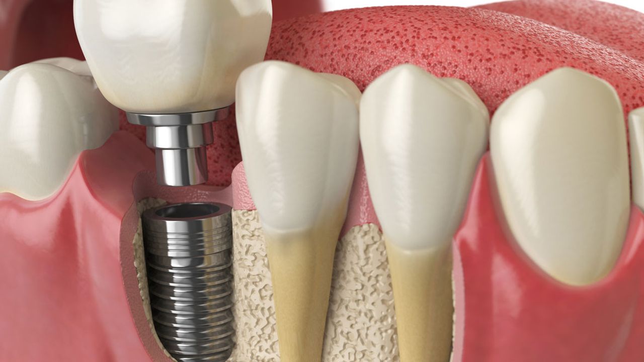 Dişlerinize implant yaptırmak istiyorsanız bunlara dikkat!