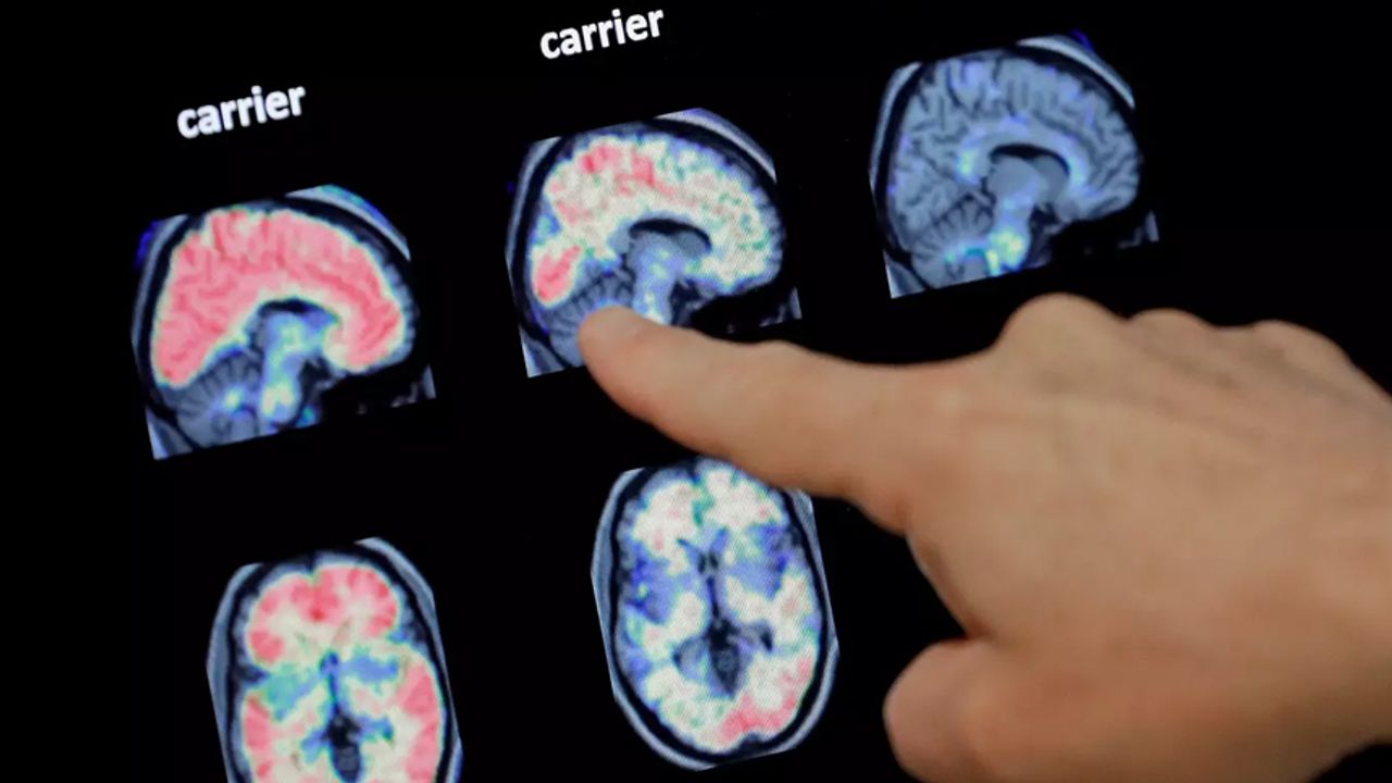Korkutan Covid-19 araştırması: Beyne etkisi yıllar sonra çıkıyor