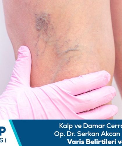 Kalp ve Damar Cerrahisi Uzmanı Op. Dr. Serkan Akcan bilgilendiriyor: Varis belirtileri ve çeşitleri