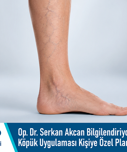 Op. Dr. Serkan Akcan Bilgilendiriyor: Varis Tedavisinde Köpük Uygulaması Kişiye Özel Planlanmalı