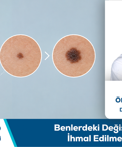 Uzm. Dr. Ömür Kocaoğlu Bilgilendiriyor: Benlerdeki Değişiklikler İhmal Edilmemeli