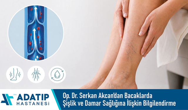 Özel Adatıp Hastanesi Op. Dr. Serkan Akcan’dan bacaklarda şişlik ve damar sağlığına ilişkin bilgilendirme