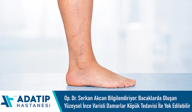 Op. Dr. Serkan Akcan bBilgilendiriyor: Bacaklarda oluşan yüzeysel ince varisli damarlar köpük tedavisi ile yok edilebili