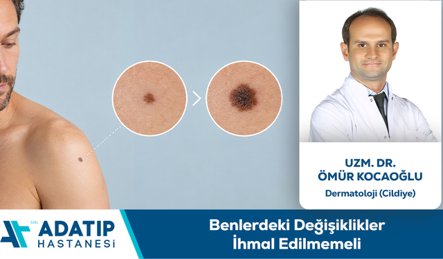 Uzm. Dr. Ömür Kocaoğlu Bilgilendiriyor: Benlerdeki Değişiklikler İhmal Edilmemeli
